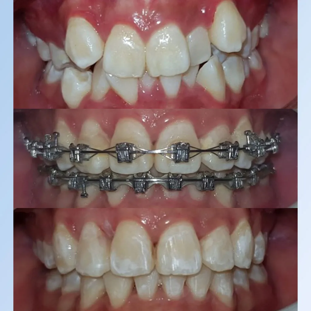 Braces before and after at Bunny Dental