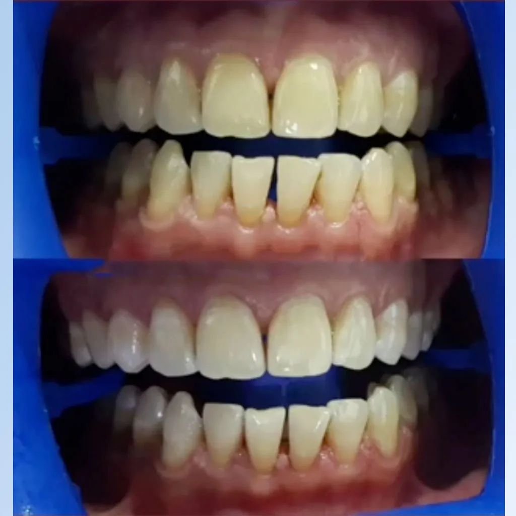 Express teeth whitening before and after at Bunny Dental