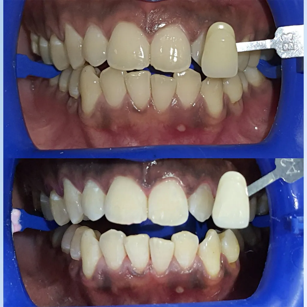 Premium teeth whitening before and after at Bunny Dental